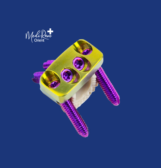 ACDF Cervical Cage – PEEK Material (Multiple Sizes)